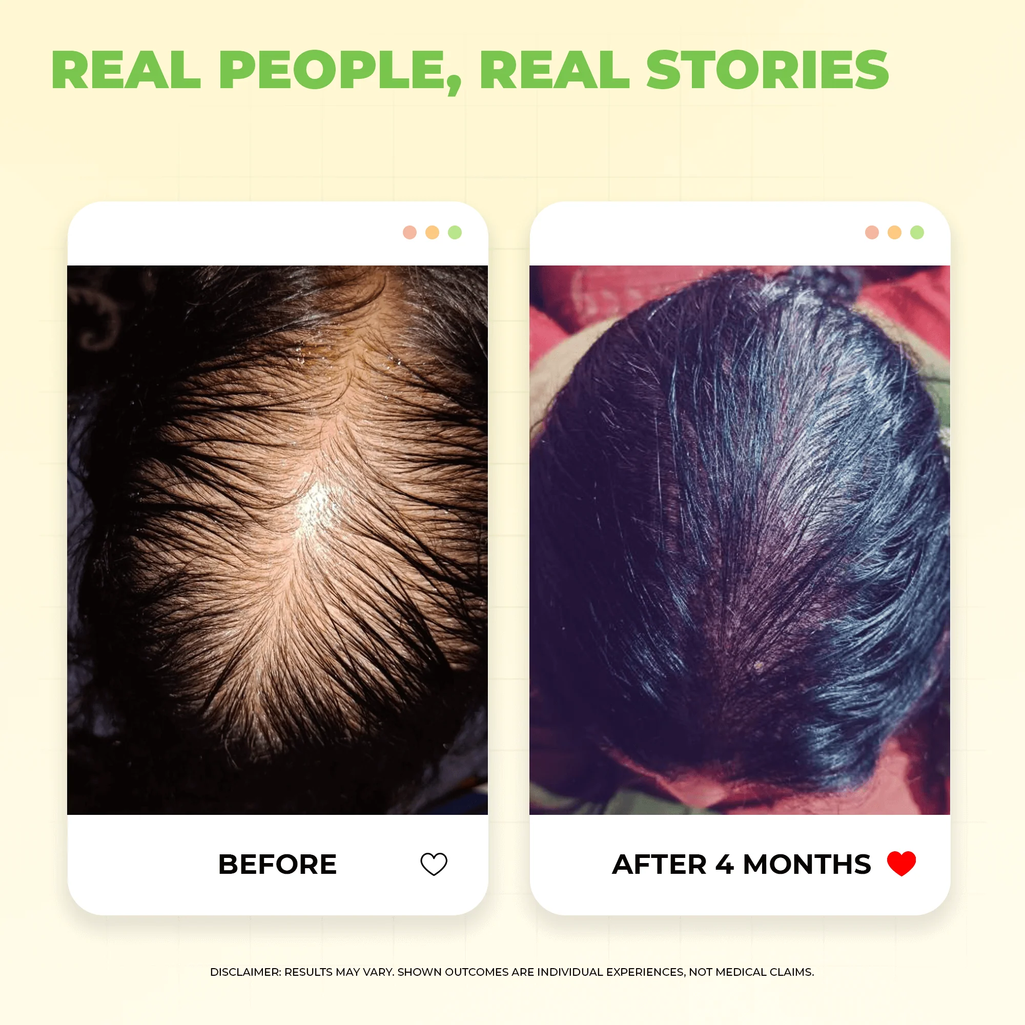 Scalptone Hair Growth Serum with 5% Nansyl & Pea Sprout Extract - Image 5