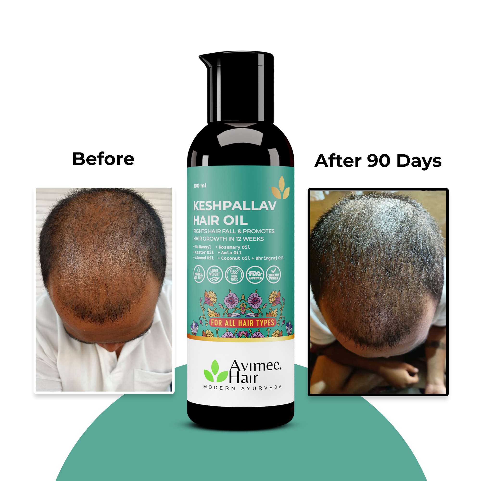 Hair Growth Kit+ for Stage 3 Hair Loss - Image 6